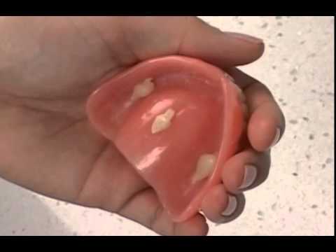 Come cambia il viso con la dentiera 4